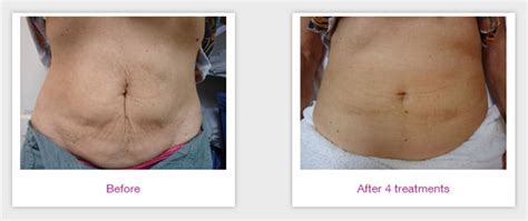 velashape tacoma|VelaShape Tacoma WA – Fresh Surgery.